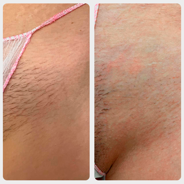 Bikini depiliacijos lazeriu rezultatas po 1 procedūros