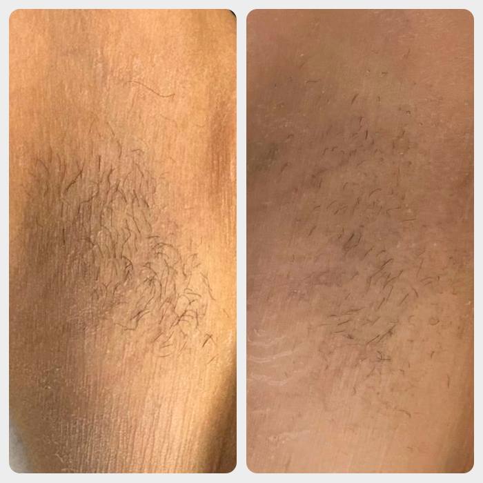 Pažastų depiliacijos lazeriu rezultatas po 1 procedūros